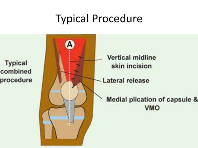 habitual dislocation of patella